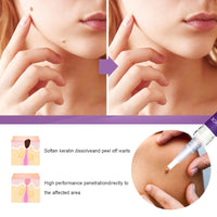 Removal Pen Fade Mole Removal Hand Foot Face