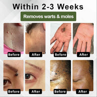 Natureerase Instant Mole Spot Removal Gel