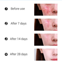Meilin Anti-Acne Freckle Shrinking Pores And Tease Cream