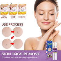Removal Pen Fade Mole Removal Hand Foot Face