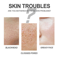 Nose Cleansing Pores Blackhead Acne Oil T-zone Care Kit