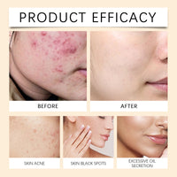 Lighten Acne Mark And Moisturize Face Cream