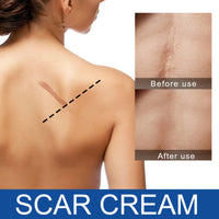 Care Reduces Scars Repairing Cream Acne Marks