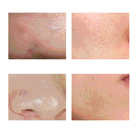 Moisturizing Acne Removing Horse Riding Dew