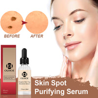 Mole Skin care lotion Repair Mole Black Spot Mole Mole Elimination Rose Essential Oil
