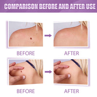 Removal Pen Fade Mole Removal Hand Foot Face